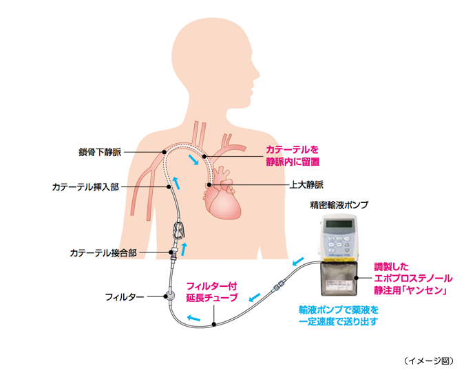 カテーテル留置の影響